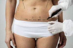 Abdominoplastia sem drenos: quais são as vantagens?
